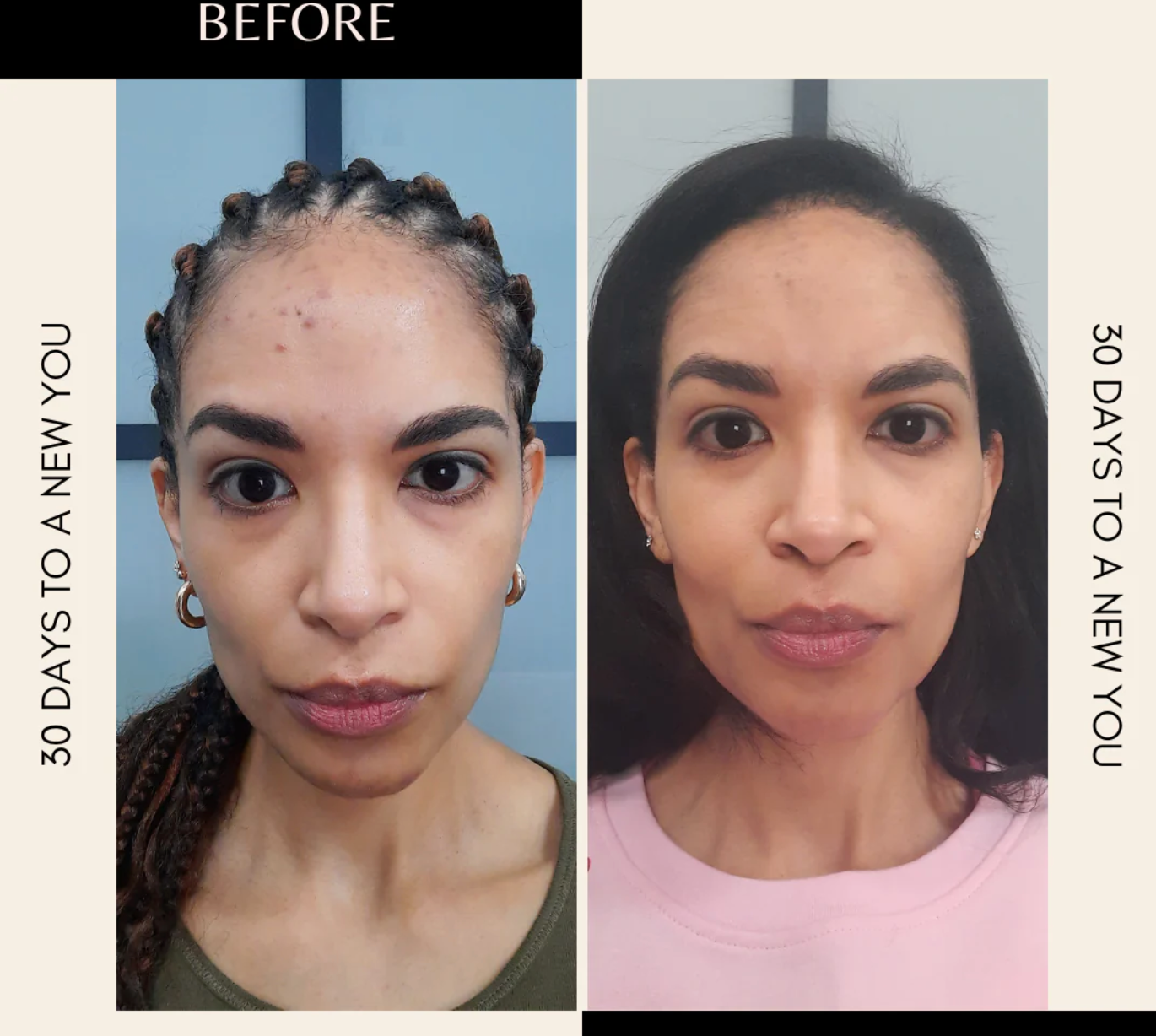 Plant-based Acne Set